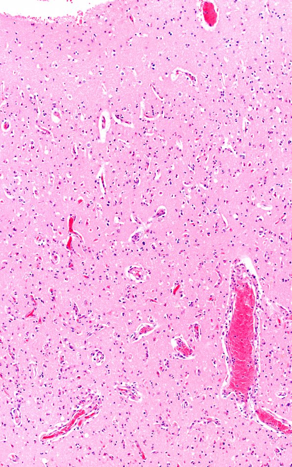 8C5A Infarct-Hypoxia Ischemia, subacute (Case 8) N5 H&E 4