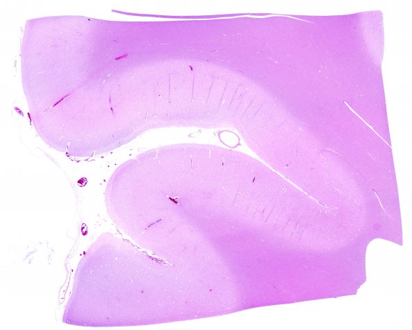 8D1 Infarct-Hypoxia Ischemia, subacute (Case 8) N1 H&E whole mount