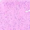 8D3 Infarct-Hypoxia Ischemia, subacute (Case 8) N1 H&E crest gyrus 10X 1