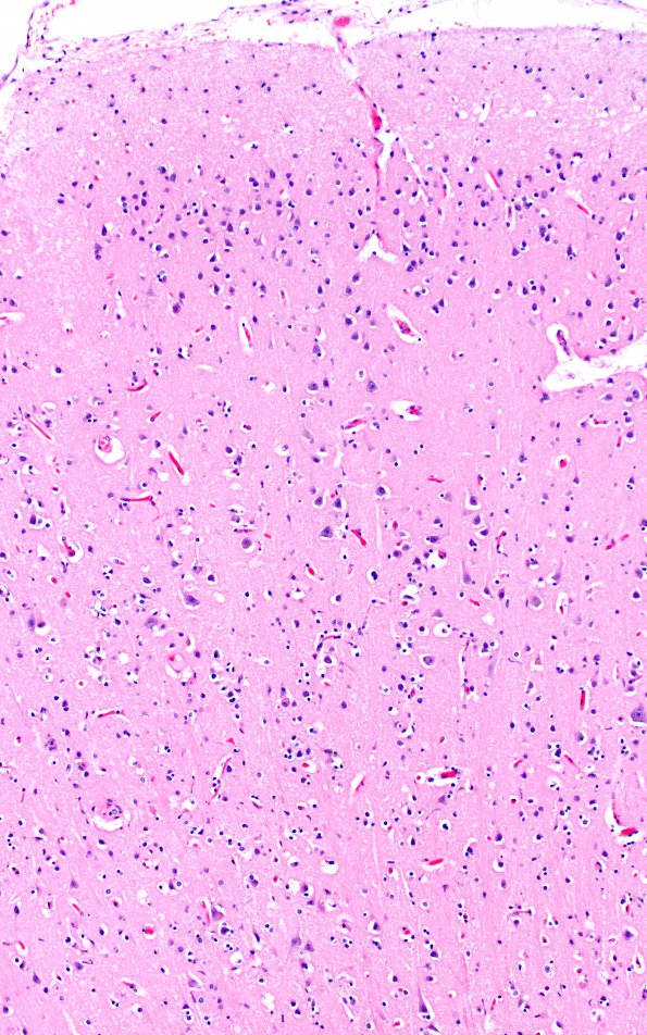 8D3 Infarct-Hypoxia Ischemia, subacute (Case 8) N1 H&E crest gyrus 10X 1