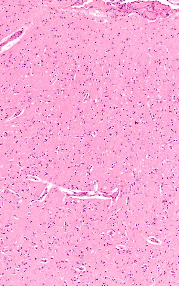 8D5 Infarct subacute (Case 8) N1 H&E depth gyrus 10X A