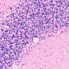 8E Infarct-Hypoxia Ischemia, subacute (Case 8) N9 H&E 1