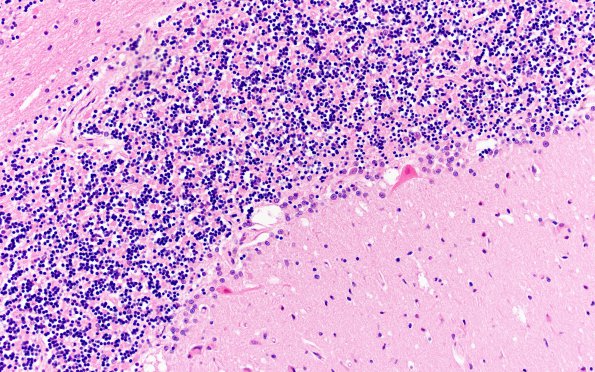 8E Infarct-Hypoxia Ischemia, subacute (Case 8) N9 H&E 1