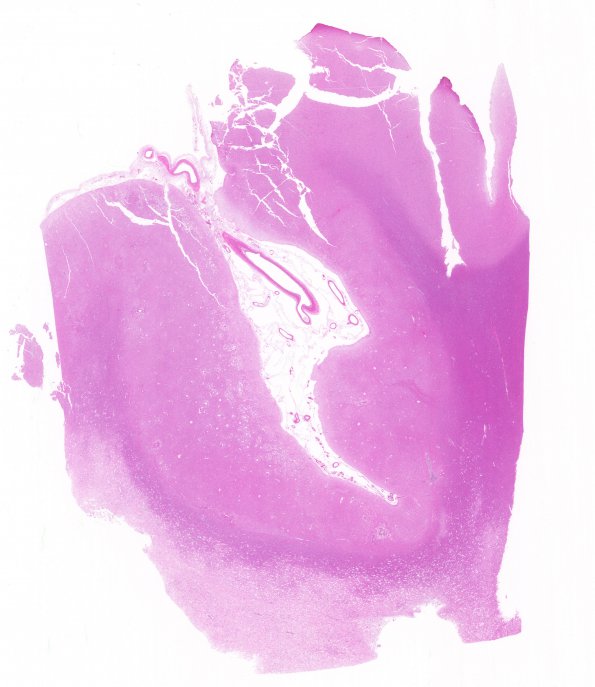 9A1 Infarct, subacute (Case 9) H&E whole mount 2