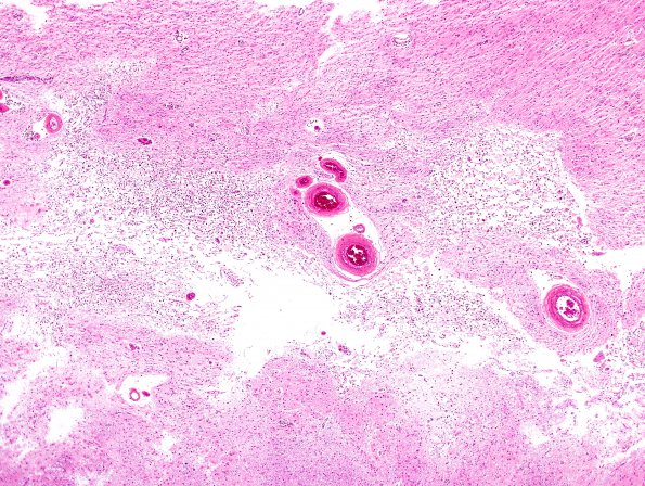 9A2 Infarct, subacute (Case 9) H&E 5