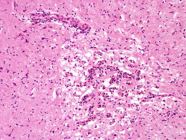 9A3 Infarct, subacute (Case 9) H&E incipient mineralization 3