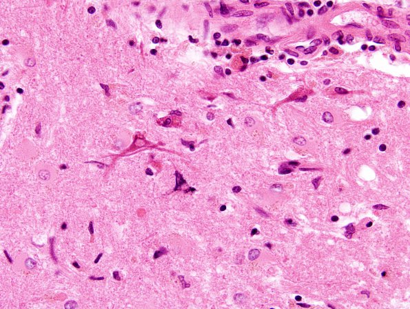 9A4 Infarct, subacute (Case 9) H&E incipient mineralization 5