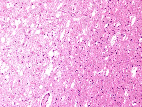 9A5 Infarct, subacute (Case 9) H&E 2