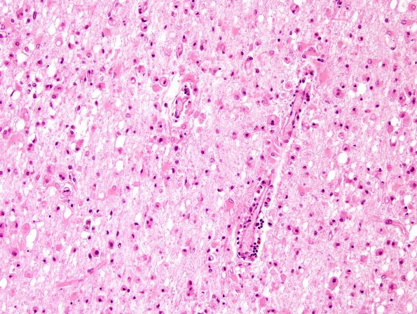 9A6 Infarct, subacute (Case 9) H&E 1