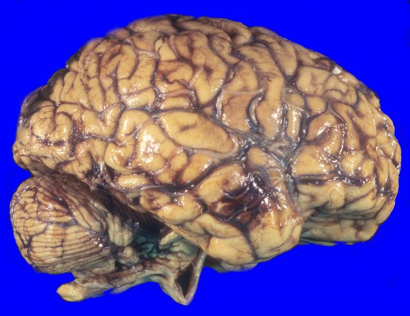 10A1 SSST, TVST, cbell infarct (Case 10) 1