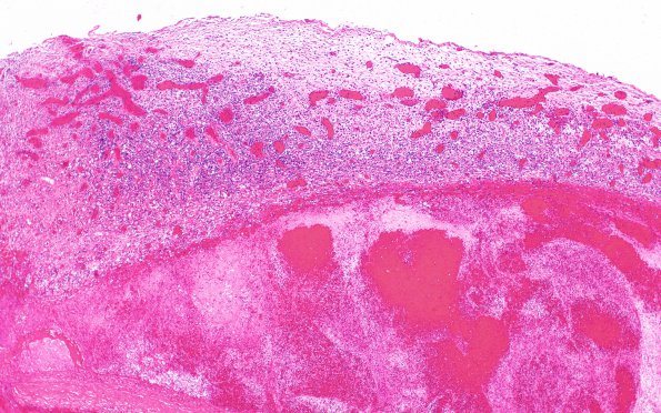 10B1 SSST, TVST, cbell infarct (Case 10) N11 H&E WM