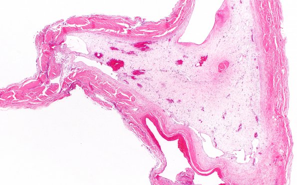 10B2 SSST, TVST, cbell infarct (Case 10) N12 H&E 2X 2