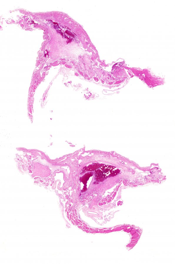 10B3 SSST, TVST, cbell infarct (Case 10) N13  h&e wm