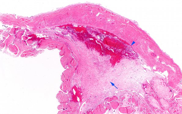 10B4 SSST, TVST, cbell infarct (Case 10) N13 H&E 2X copy