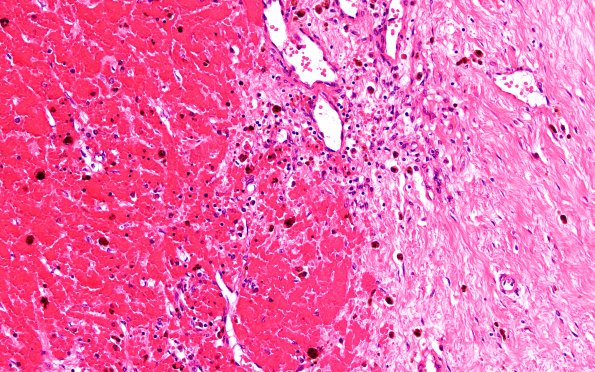 10B5 SSST, TVST, cbell infarct (Case 10) N13B H&E 20X