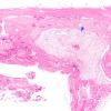 10B6 SSST, TVST, cbell infarct (Case 10) N14 H&E 2X copy