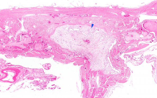 10B6 SSST, TVST, cbell infarct (Case 10) N14 H&E 2X copy