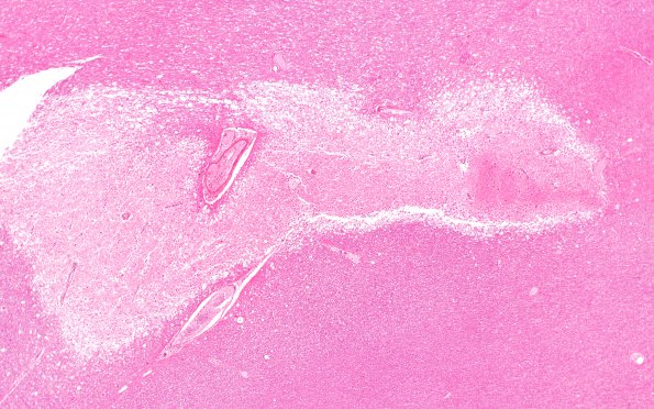 10C1 SSST, TVST, cbell infarct (Case 10) N15 H&E 4X 3