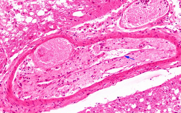 10C3 SSST, TVST, cbell infarct (Case 10) N15 H&E 40X 2 copy