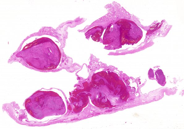 11C1 SSST,SST & TVST (Case 11) F2