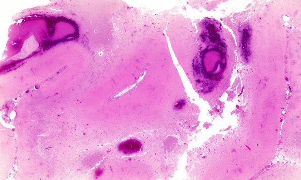 11C3 SSST & (SS,TV sinuses)( Case 11) H&E N5R H&E WM