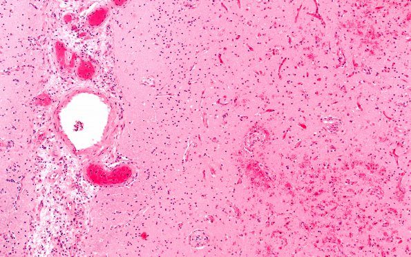 11C4 SSST & (SS,TV sinuses) (Case 11) H&E 4X 3