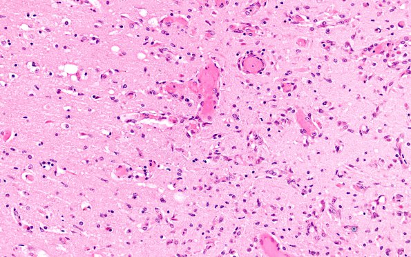 11C6 SSST & (SS,TV sinuses) (Case 11) H&E N1R H&E 20X