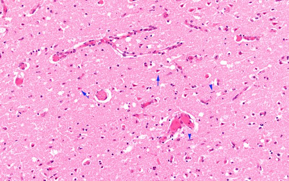 11C7 SSST & (SS,TV sinuses) (Case 11 H&E 20X 2 copy