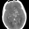 1A1 Infarct, venous, ST & ICV thrombus (Case 1) CT 2