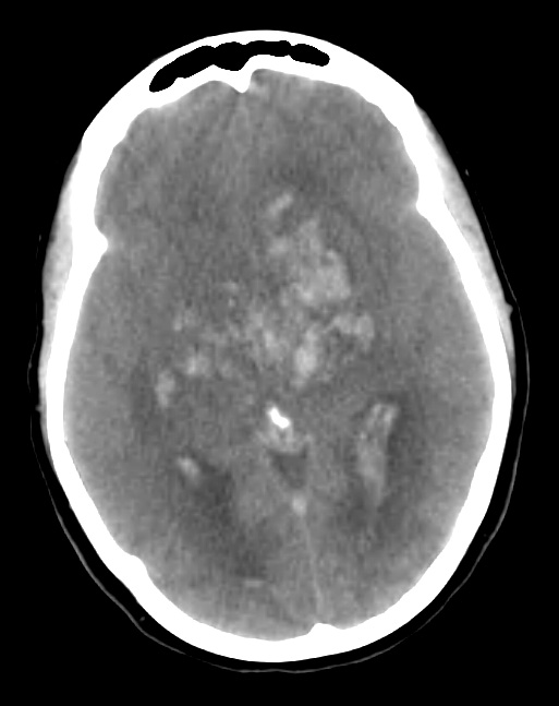 1A1 Infarct, venous, ST & ICV thrombus (Case 1) CT 2