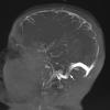 1A2 Infarct, venous, ST & ICV thrombus (Case 1) MRV TOF MIP 1A