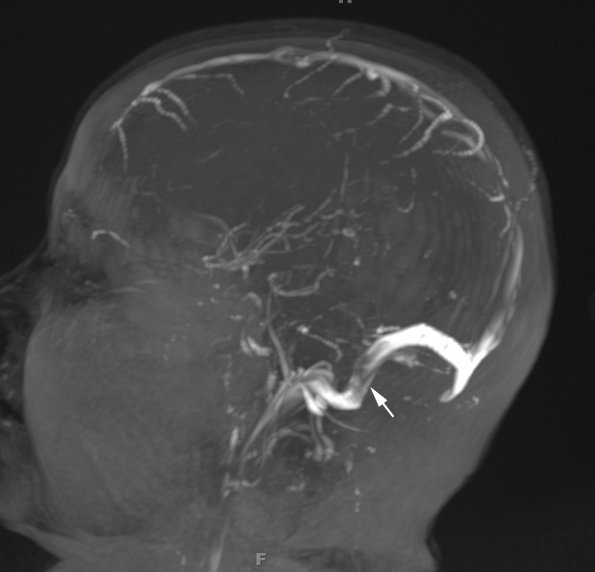 1A2 Infarct, venous, ST & ICV thrombus (Case 1) MRV TOF MIP 1A