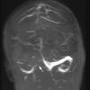 1A3 Infarct, venous, ST & ICV thrombus (Case 1) MRV TOF MIP 2 copy