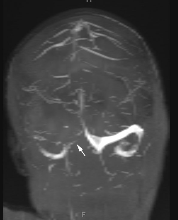 1A3 Infarct, venous, ST & ICV thrombus (Case 1) MRV TOF MIP 2 copy