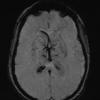 1A4 Infarct, venous, ST & ICV thrombus (Case 1) SWI 1