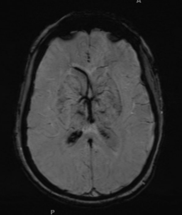 1A4 Infarct, venous, ST & ICV thrombus (Case 1) SWI 1