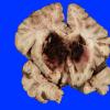 1B1 Infarct, venous, ST & ICV thrombus (Case 1) 8