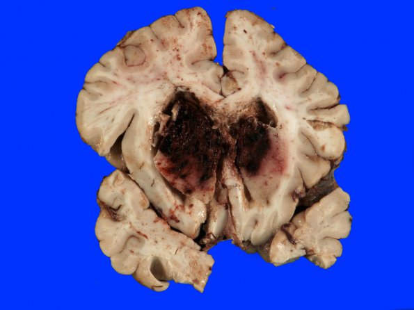 1B1 Infarct, venous, ST & ICV thrombus (Case 1) 8