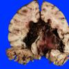 1B2 Infarct, venous, ST & ICV thrombus (Case 1) 10