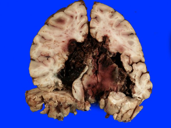 1B2 Infarct, venous, ST & ICV thrombus (Case 1) 10