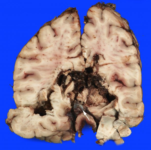 1B3 Infarct, venous, ST & ICV thrombus (Case 1) 11 copy