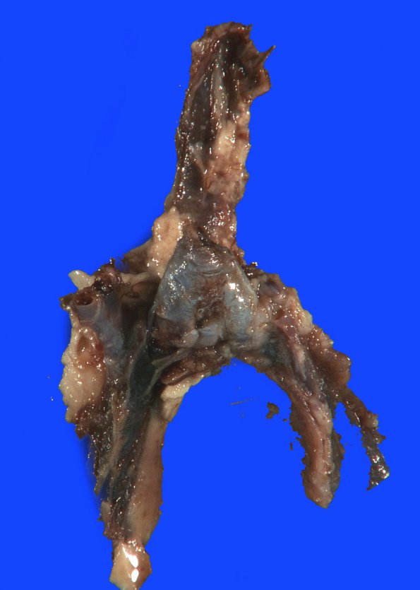 1B4 Infarct, venous, ST & ICV thrombus (Case 1) 19A