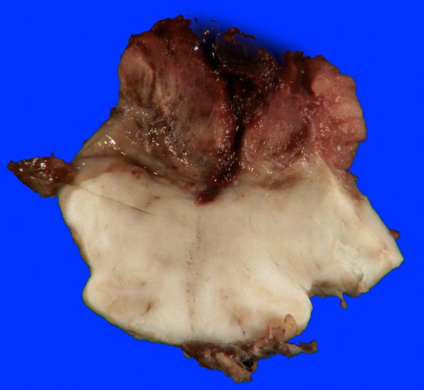 1B6 Infarct, venous, ST & ICV thrombus (Case 1) 6