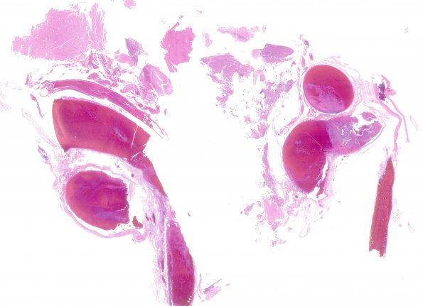 1C1 Infarct, venous, ST & ICV thrombus (Case 1) N12 H&E WM