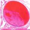 1C2 Infarct, venous, ST & ICV thrombus (Case 1) N12 IC veins H&E 15