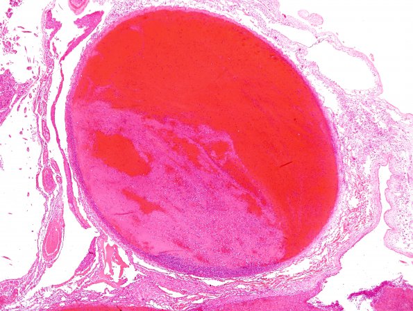 1C2 Infarct, venous, ST & ICV thrombus (Case 1) N12 IC veins H&E 15