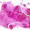 1C3 Infarct, venous, ST & ICV thrombus (Case 1) N2 H&E WM