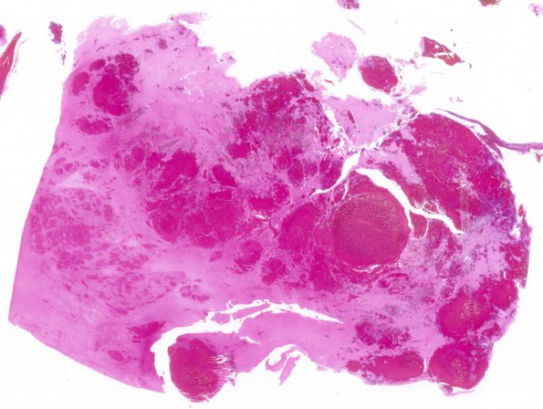 1C3 Infarct, venous, ST & ICV thrombus (Case 1) N2 H&E WM