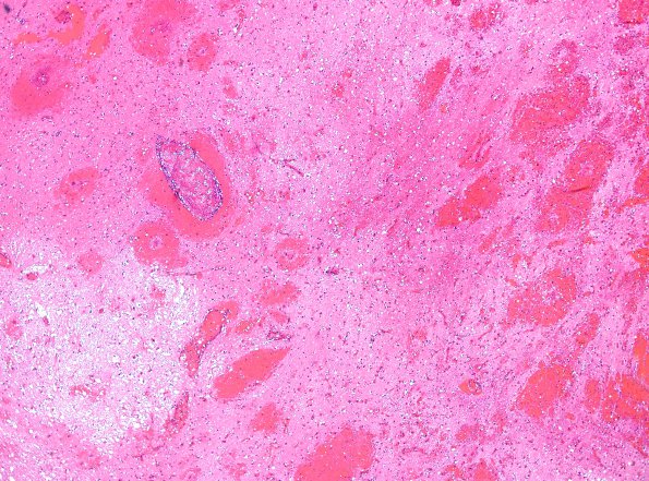 1C4 Infarct, venous, ST & ICV thrombus (Case 1) H&E 13