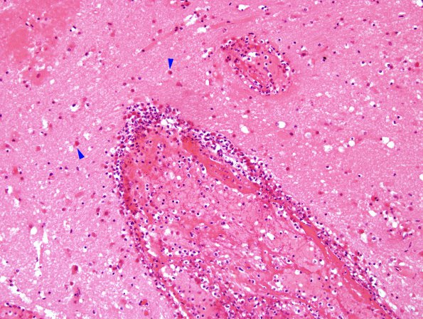 1C5 Infarct, venous, ST & ICV thrombus (Case 1) H&E 10 copy